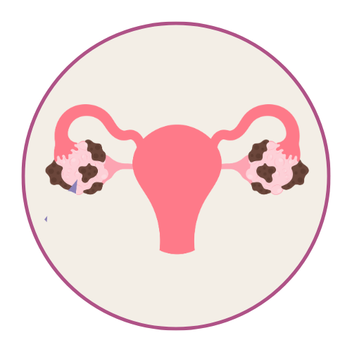 Categoria Sindrome ovaio policistico